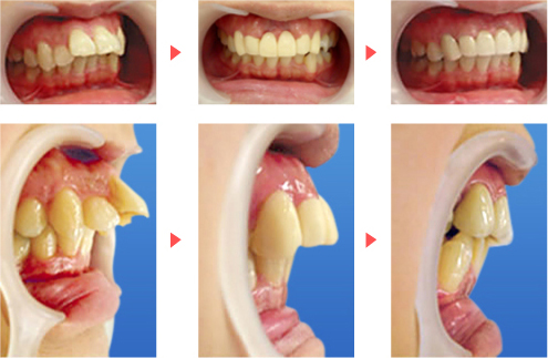 歯茎ごと出ている出っ歯の治療法 ザ ホワイトデンタルクリニック