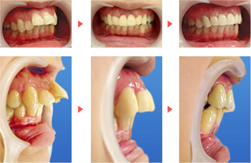 前歯2本の突出でお悩みの20代女性