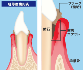 歯周病の進行を止める
