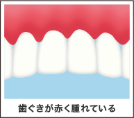 歯茎が赤くはれている