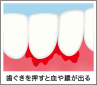 歯茎を押すと血や膿が出る