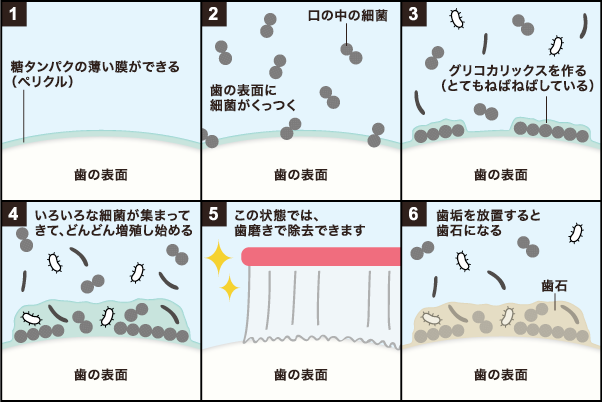 歯周病と歯石の関係 ザ・ホワイトデンタルクリニック